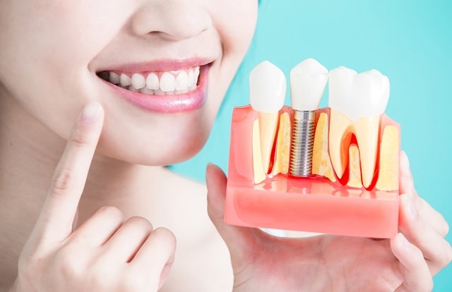 all about dental implants confident smile