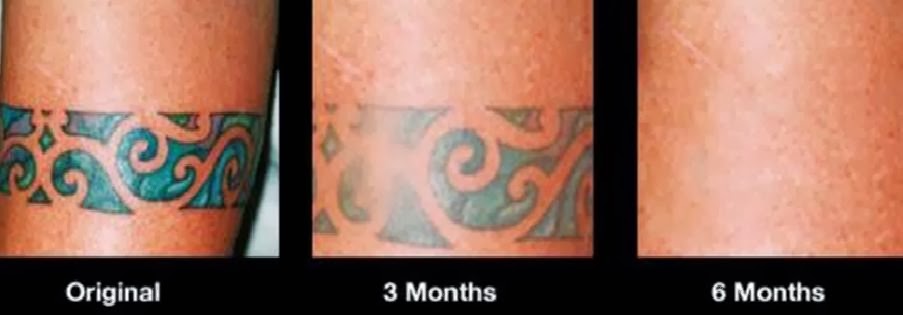 tattoo removal cream, before and after photos of tattoo removal cream ...