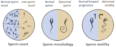 Causes and Treatment for Nil Sperms