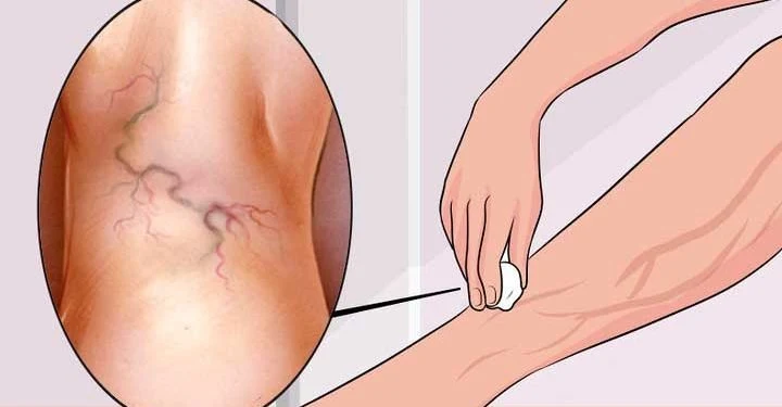 Exercises To Make Your Varicose Veins Disappear Quickly