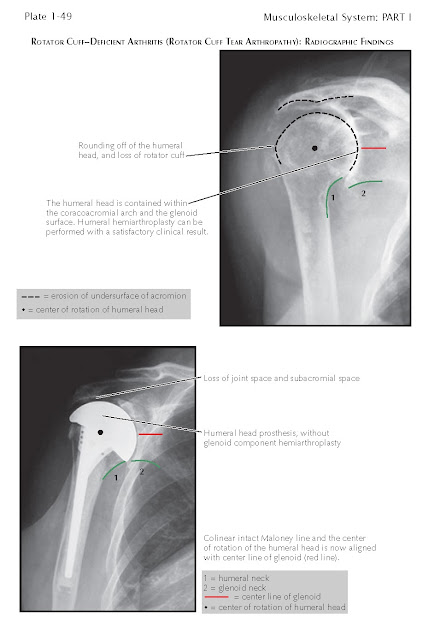 Rotator Cuff–Deficient Arthritis (Rotator Cuff Tear Arthropathy)