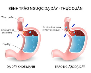 Chữa trị trào ngược dạ dày thực quản