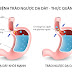 Chữa trị trào ngược dạ dày thực quản không khó như bạn nghĩ