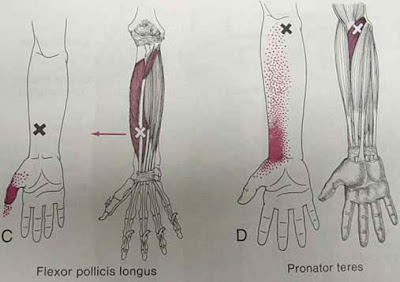 MIOTERAPIA