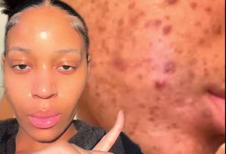 Hormonal Acne Skincare Routine for Black Skin: Expert tips