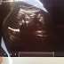 On C-Sections...And How I Finally Made Peace With My Body
