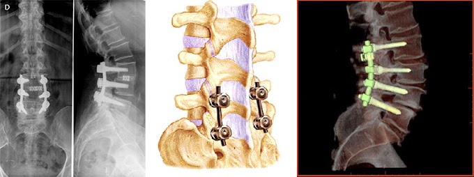 Hospital Gautier inicia jornada de cirugías de columna vertebral