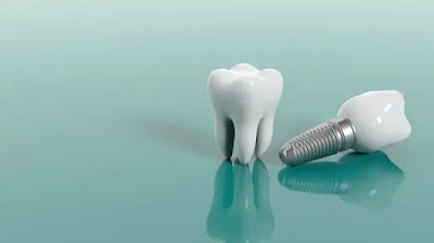 dental implant price