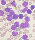 leukemia, cancer, treatment, make me health