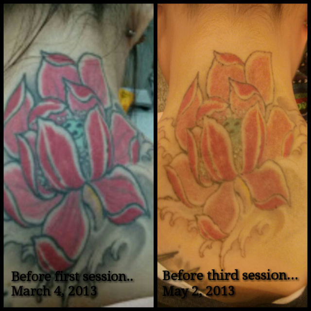 This picture is the status of my tattoo BEFROE the 3rd session removal ...