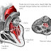 Stenosis Aorta