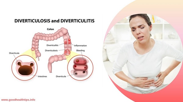 Diverticulitis The cause and treatment of this disease