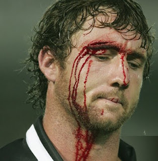 Worst Sports Injuries 5