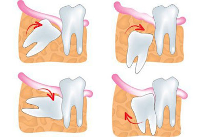 Chữa trị đau nhức khi mọc răng khôn thế nào?