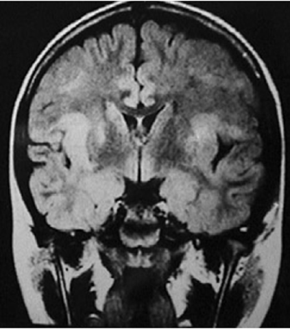 abnormal mri brain