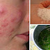 7 Cystic Acne Home Remedies that Really Work
