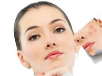 Natural Treatments for Acne – Is there any Natural treatment for you acne Problem?