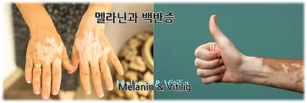 멜라닌 색소와 백반증이란 무엇인가?