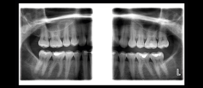Естраорални сегментни и bite wing рентгенографии