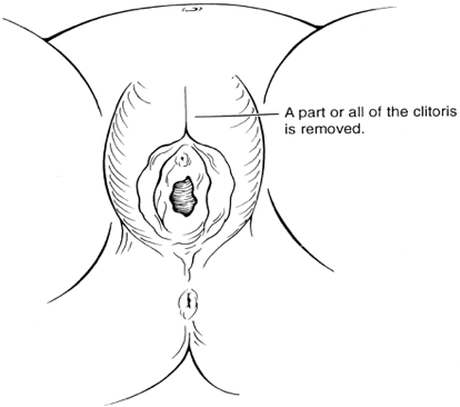 In type two called an excision the entire clitoris is removed and part or