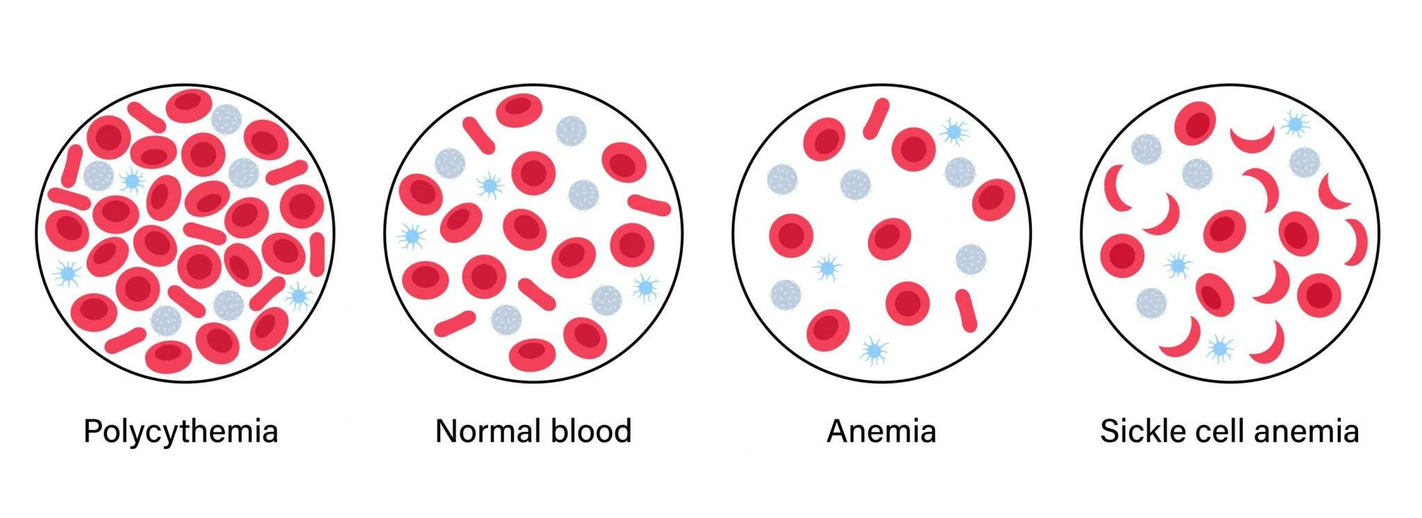 Diseases Related to Hemoglobin