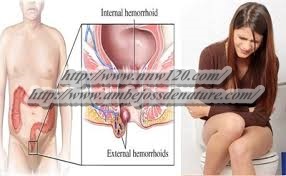 Obat Ambeien Untuk Wanita Menyusui