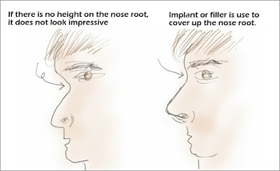 rhinoplasty