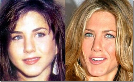 jennifer aniston surgery before after. Jennifer Aniston: