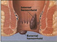 Nursing Care Plan for Hemorrhoids