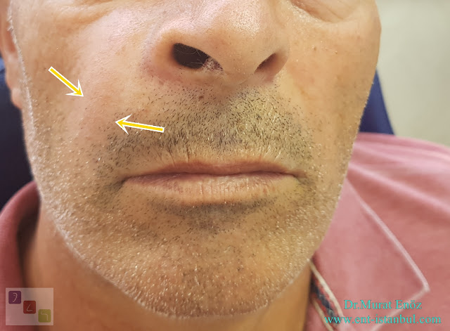 Carcinoma Ex Pleomorphic Adenoma of The Hard Palate