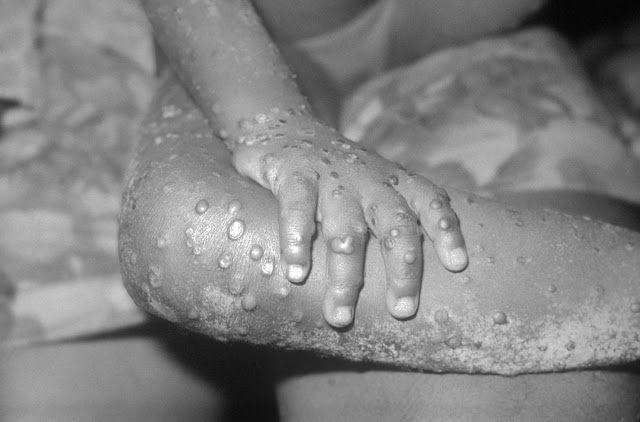 monkeypox disease outbreak