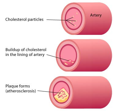 cholesterol