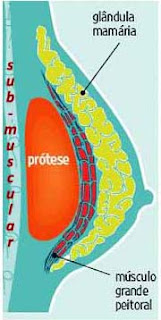 implante sub muscular