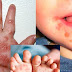 Bệnh tay chân miệng: Các biện pháp phòng ngừa (nguồn  https://vncdc.gov.vn/benh-tay-chan-mieng-cac-bien-phap-phong-ngua-nd16959.html)