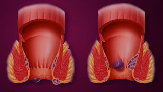 البواسير كيف تعالج البواسير بطريقة % طبيعية 