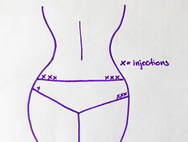 insulin injection sites