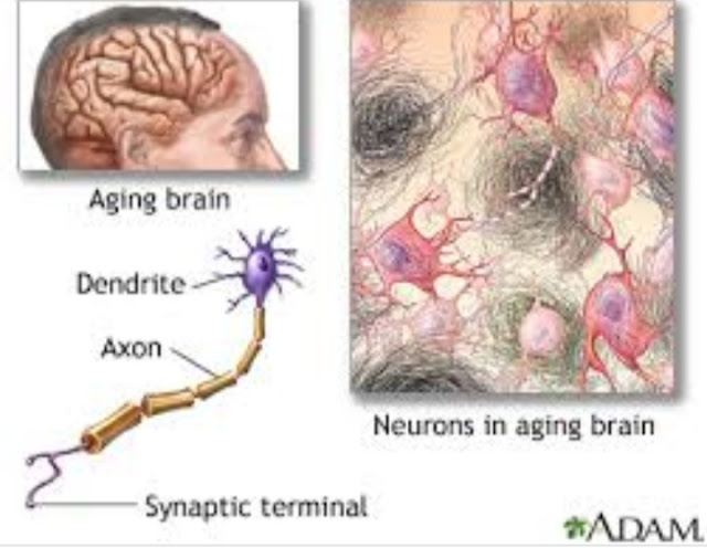Alzheimer's Disease Symptoms Remedy