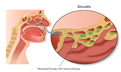 Askep Sinusitis Nanda Nic Noc Terbaru