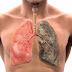 Τσιγάρο και πνεύμονες: Αντέχετε την αλήθεια; Σκληρές εικόνες