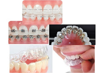 Quy trình niềng răng móm thẩm mỹ-2