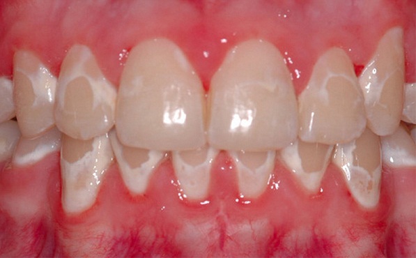 Răng có thể bị nhiễm một số bệnh lý sau khi tháo mắc cài