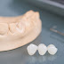 Răng sứ cercon là gì