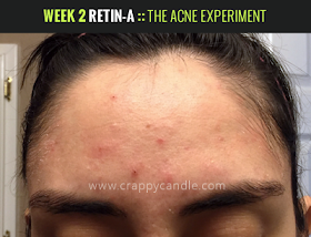 Week 2 on Retin-A :: The Acne Experiment