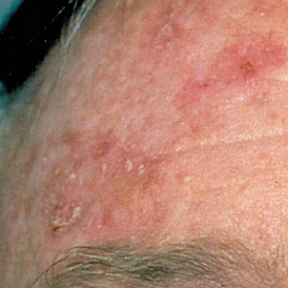 Actinic Keratosis disease | Diseasezero