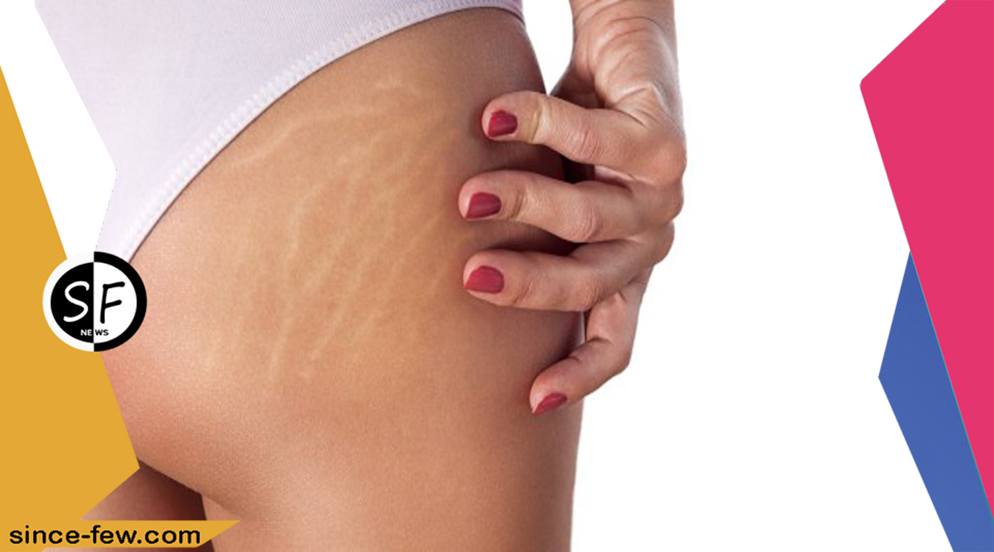 Get Rid of Cellulite At Home by Massaging And Eating Foods rich in Omega 3