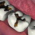 Những dấu hiệu nhận biết sâu răng ở trẻ em