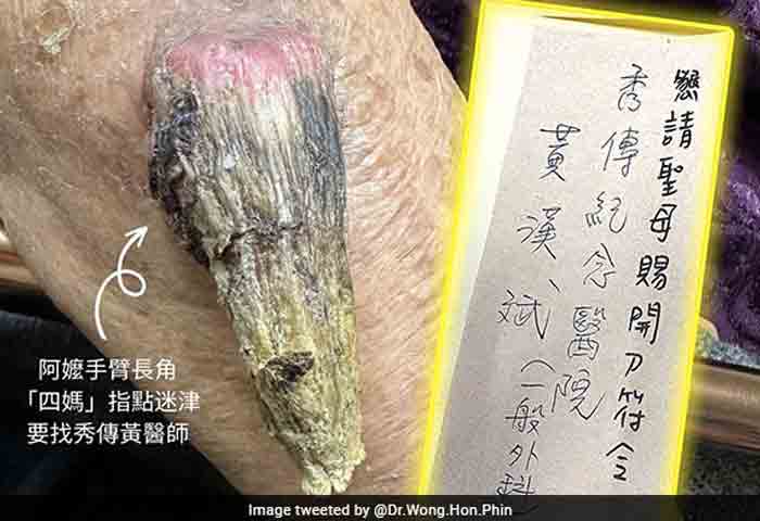 Latest-News, World, Top-Headlines, Viral, Social-Media, Woman, Report, Ultra-Rare 'Fairy' Horn Grows On Woman's Arm In Taiwan.