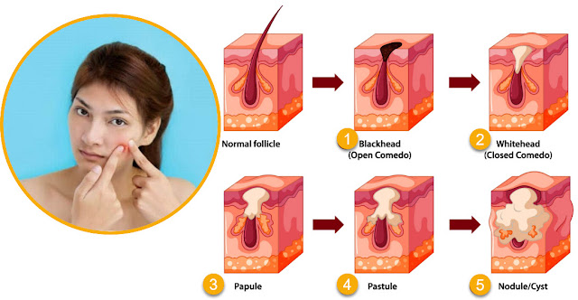 The main cause of acne is clogging of skin pores by excess production of oil (sebum) and sweat. Acne bacteria is not the trigger. In fact, acne bacteria are often referred to as good bacteria. This is because these bacteria can trigger the production of glycerin and fatty acids which are useful for skin beauty.  However, when sebum and dead skin cells clog a pore, acne bacteria grow. These growths cause inflammation plus sebum, which triggers irritation skin. As a result, those annoying pimples appear on your face.