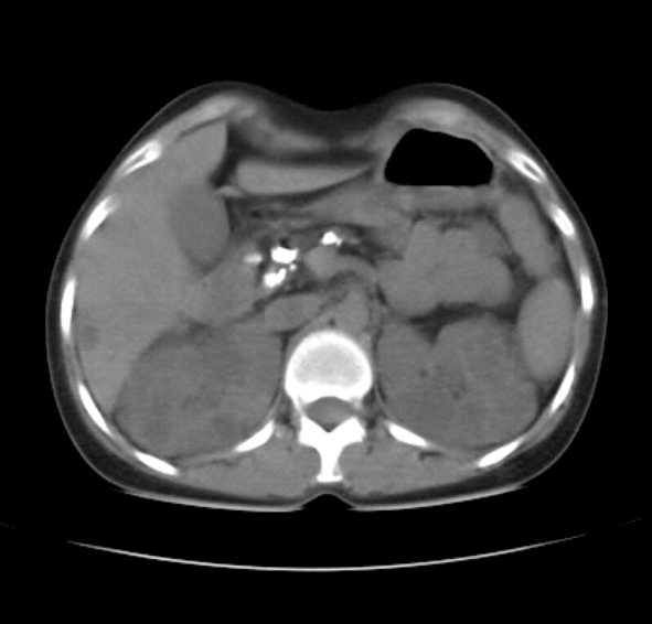 Pancreatitis-CT & MRI