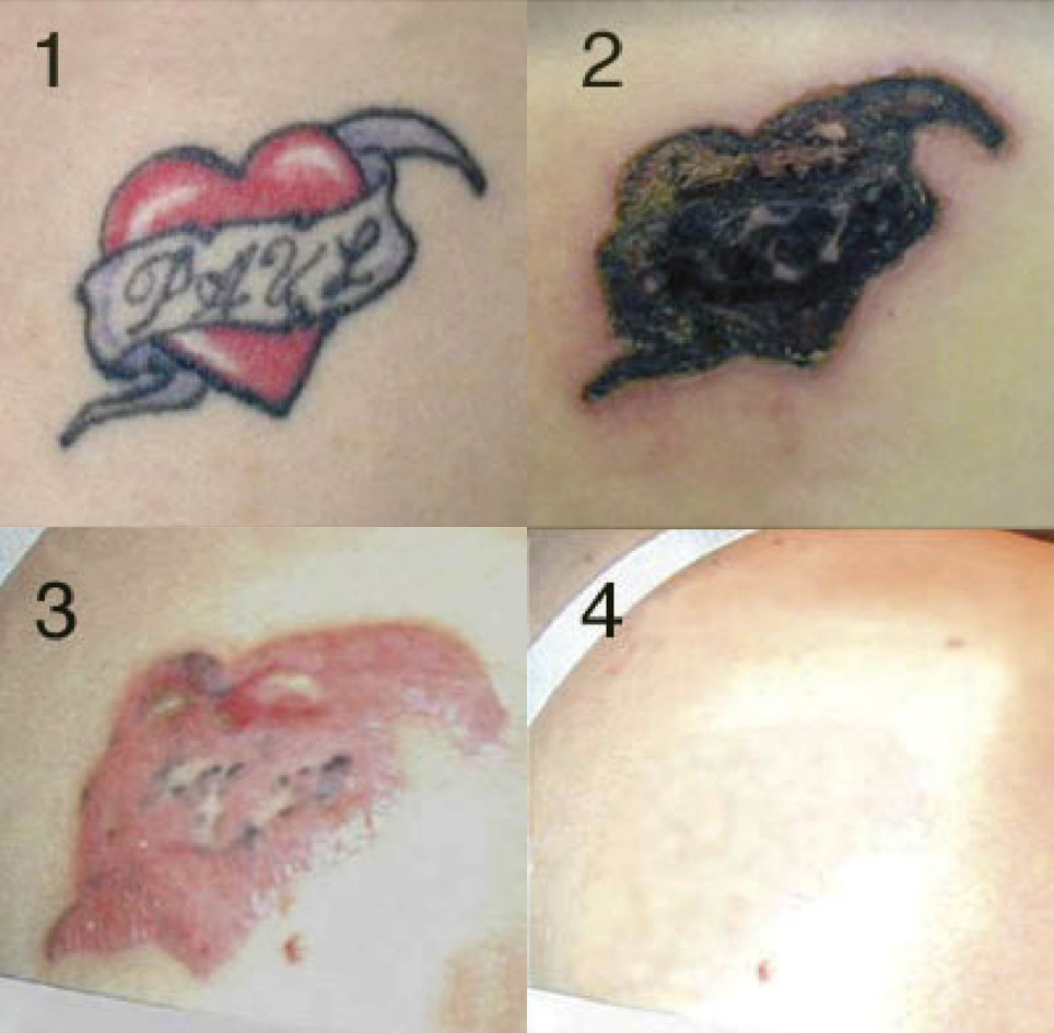 Removing A Tattoo - Closely